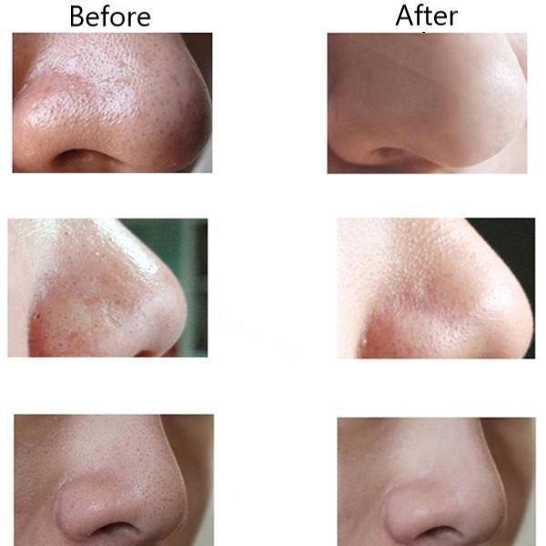 Vacuum Pore Cleaner Pro